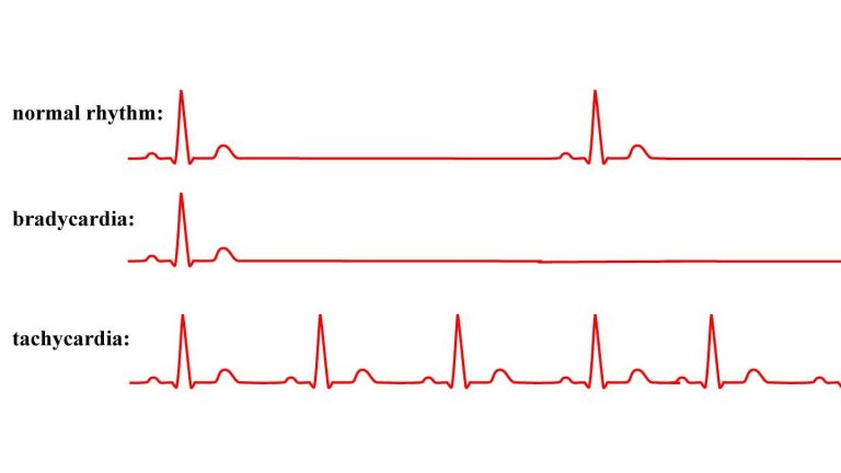 aritmija srca